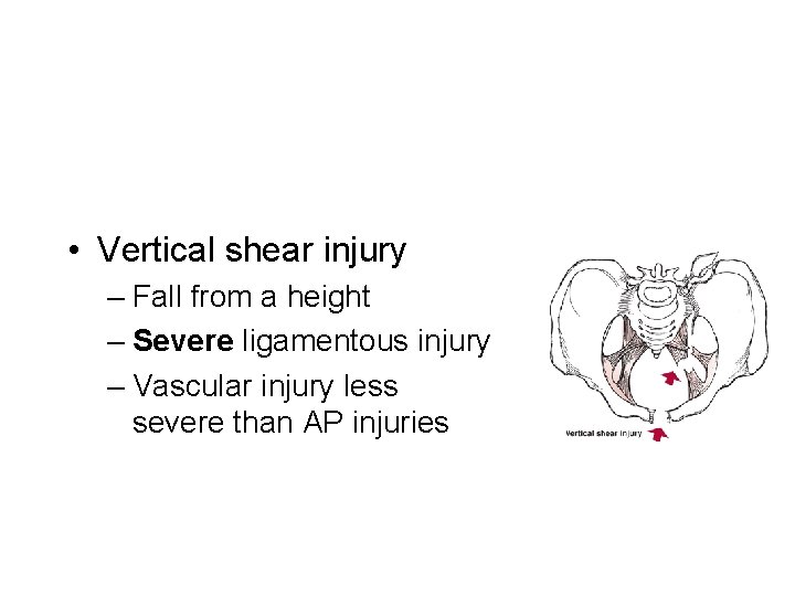 • Vertical shear injury – Fall from a height – Severe ligamentous injury