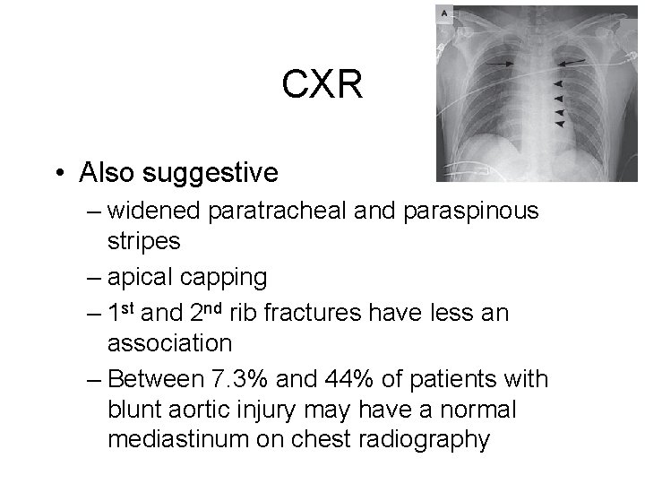 CXR • Also suggestive – widened paratracheal and paraspinous stripes – apical capping –