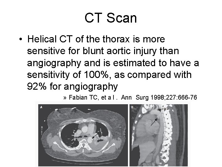 CT Scan • Helical CT of the thorax is more sensitive for blunt aortic