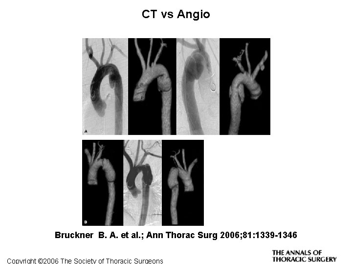 CT vs Angio Bruckner B. A. et al. ; Ann Thorac Surg 2006; 81:
