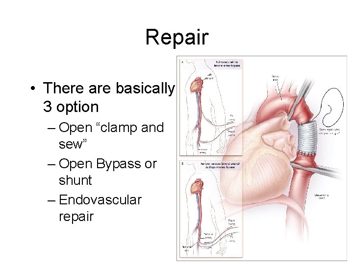 Repair • There are basically 3 option – Open “clamp and sew” – Open