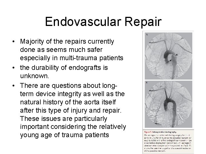 Endovascular Repair • Majority of the repairs currently done as seems much safer especially