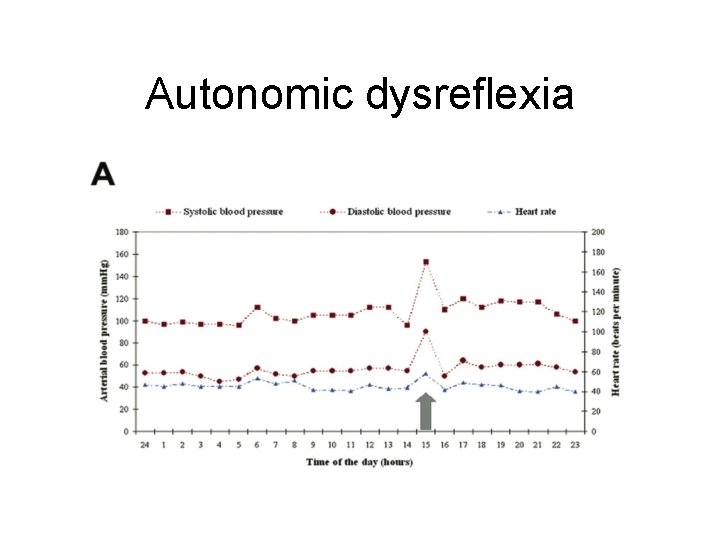Autonomic dysreflexia 
