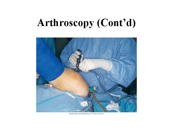 Arthroscopy (Cont’d) 