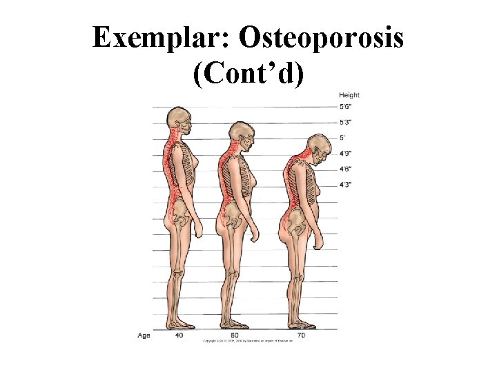 Exemplar: Osteoporosis (Cont’d) 