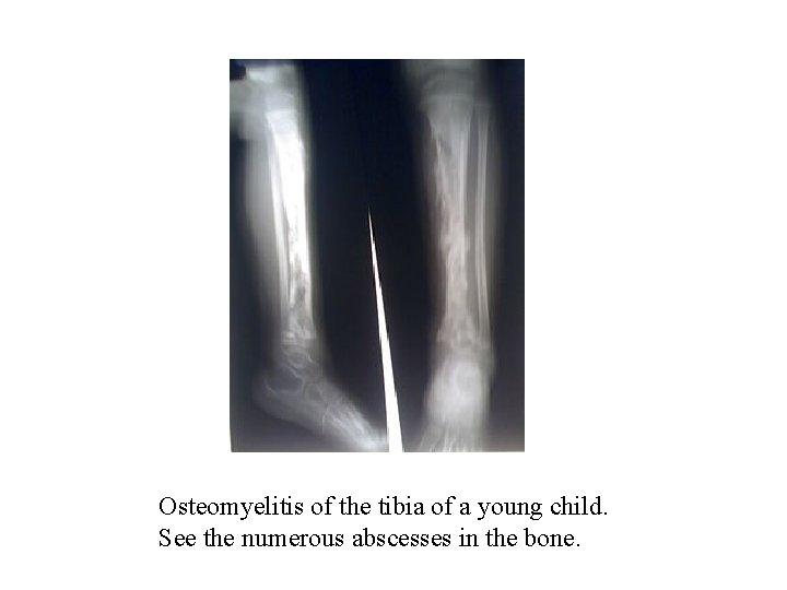 Osteomyelitis of the tibia of a young child. See the numerous abscesses in the