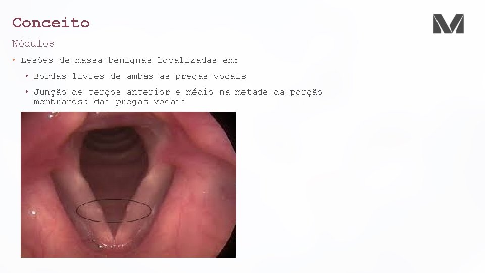 Conceito Nódulos • Lesões de massa benignas localizadas em: • Bordas livres de ambas