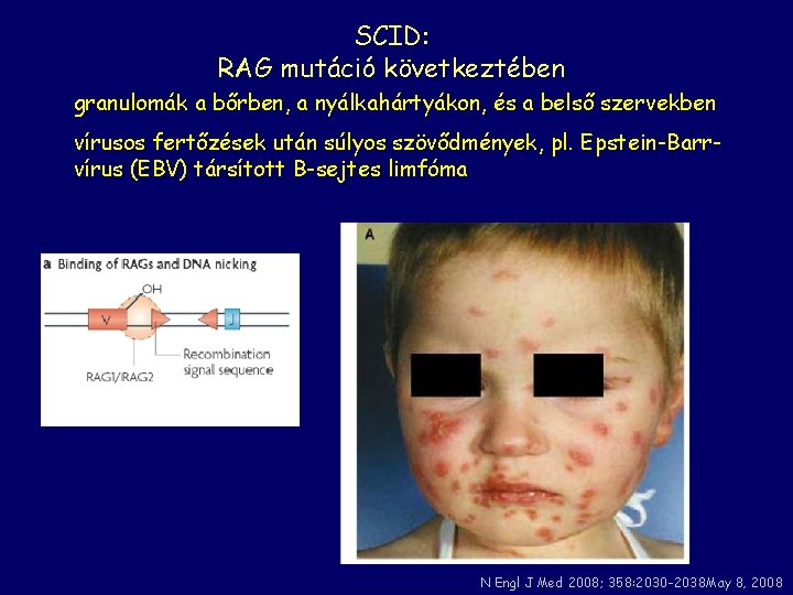 SCID: RAG mutáció következtében granulomák a bőrben, a nyálkahártyákon, és a belső szervekben vírusos