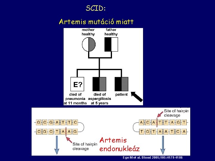 SCID: . Artemis mutáció miatt Artemis endonukleáz Ege M et al. Blood 2005; 105: