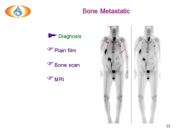 Bone Metastatic Diagnosis FPlain film FBone scan FMRI 23 