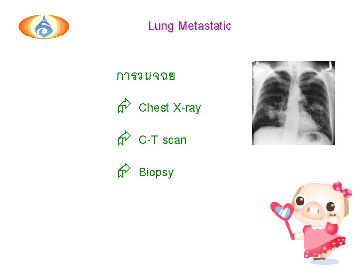 Lung Metastatic การวนจฉย Chest X-ray C-T scan Biopsy 