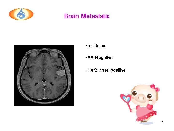Brain Metastatic -Incidence -ER Negative -Her 2 / neu positive 51 