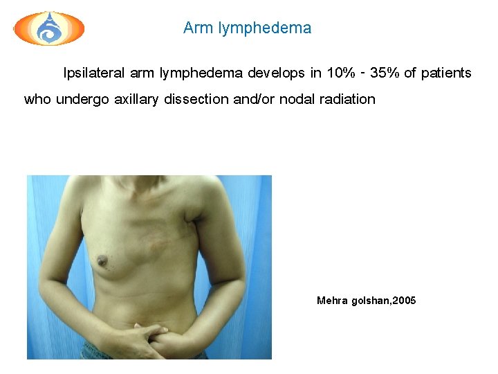 Arm lymphedema Ipsilateral arm lymphedema develops in 10% - 35% of patients who undergo