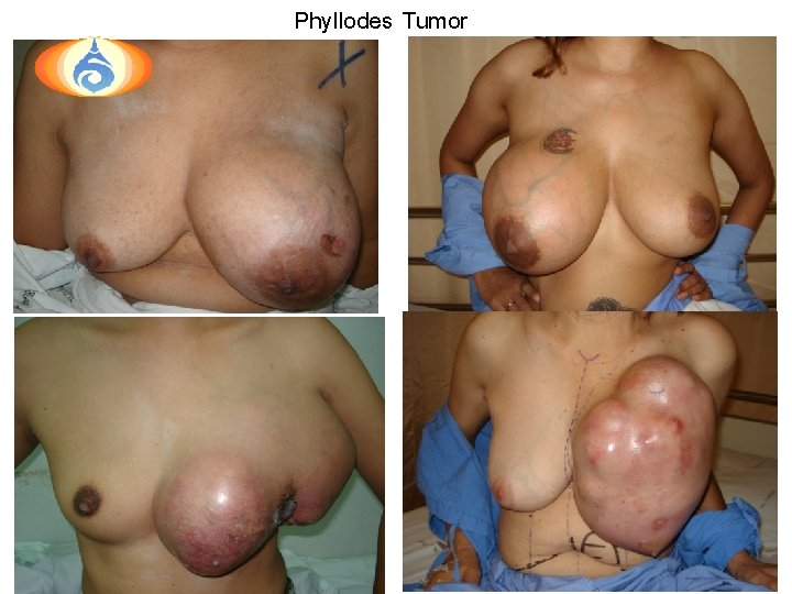 Phyllodes Tumor 