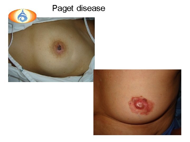 Paget disease 