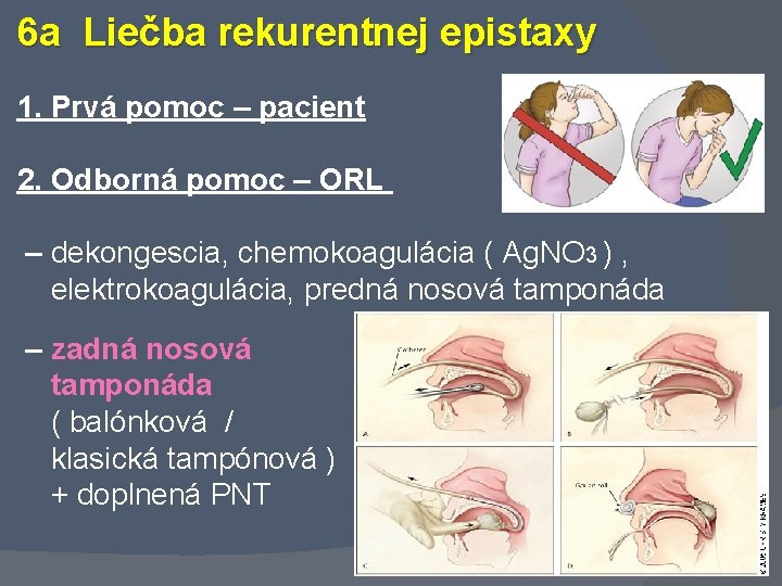 6 a Liečba rekurentnej epistaxy 1. Prvá pomoc – pacient 2. Odborná pomoc –