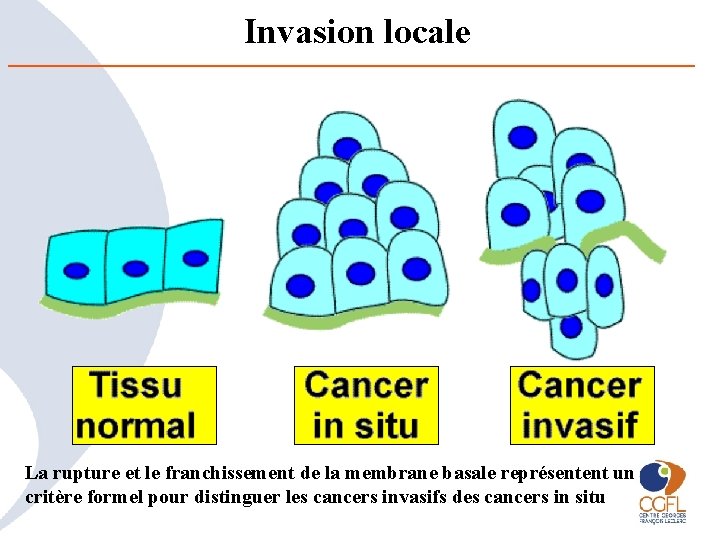 Invasion locale La rupture et le franchissement de la membrane basale représentent un critère