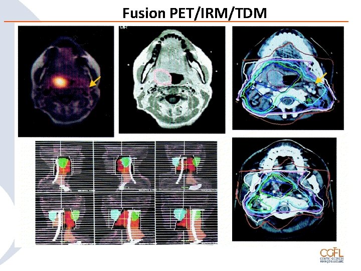 Fusion PET/IRM/TDM 