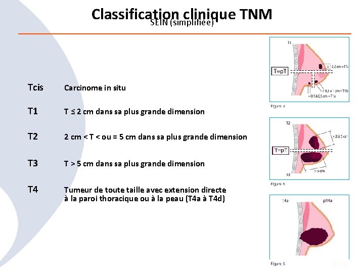 Classification clinique TNM SEIN (simplifiée) Tcis Carcinome in situ T 1 T ≤ 2