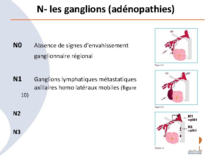 N- les ganglions (adénopathies) N 0 Absence de signes d’envahissement N 1 Ganglions lymphatiques