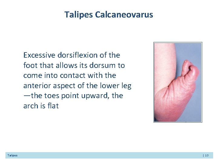 Talipes Calcaneovarus Excessive dorsiflexion of the foot that allows its dorsum to come into