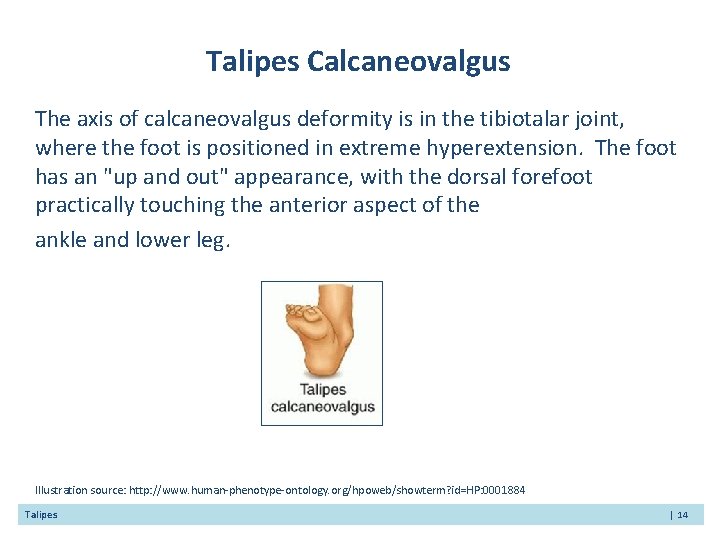 Talipes Calcaneovalgus The axis of calcaneovalgus deformity is in the tibiotalar joint, where the