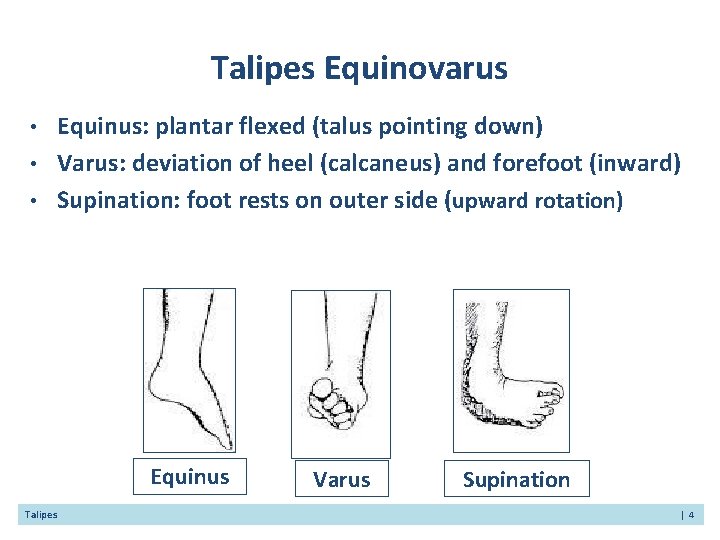 Talipes Equinovarus • • • Equinus: plantar flexed (talus pointing down) Varus: deviation of