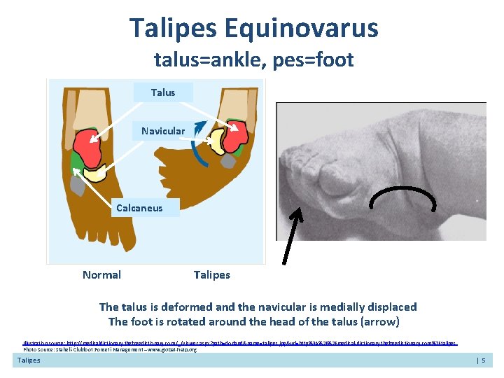 Talipes Equinovarus talus=ankle, pes=foot Talus Navicular Calcaneus Normal Talipes The talus is deformed and