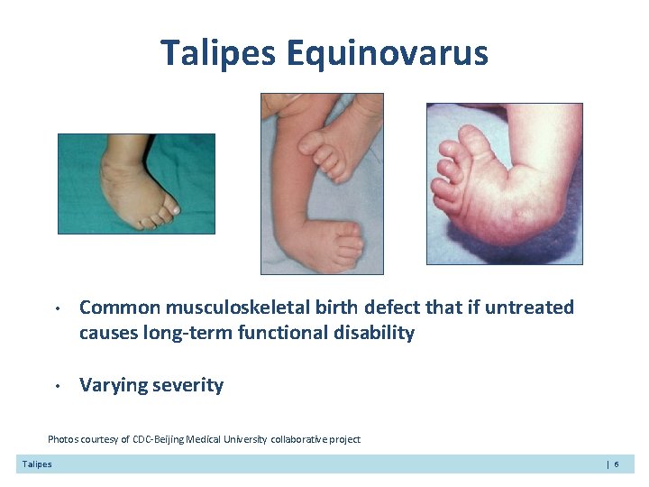 Talipes Equinovarus • Common musculoskeletal birth defect that if untreated causes long-term functional disability