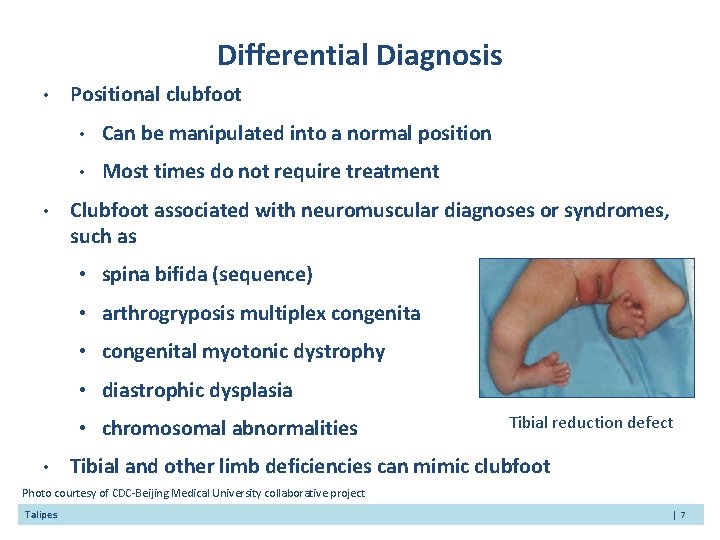 Differential Diagnosis • • Positional clubfoot • Can be manipulated into a normal position