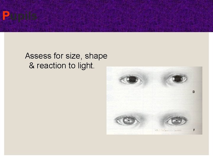 Pupils Assess for size, shape & reaction to light. Pupils Assess for size, shape & reaction to light.