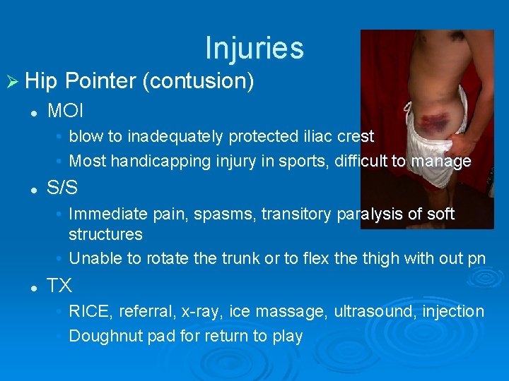 Injuries Ø Hip Pointer (contusion) l MOI • blow to inadequately protected iliac crest