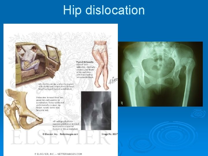 Hip dislocation 