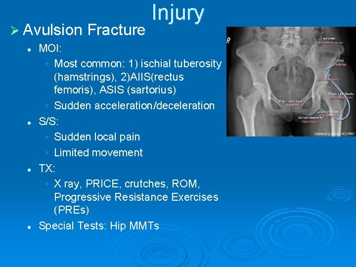 Ø Avulsion Fracture l l Injury MOI: • Most common: 1) ischial tuberosity (hamstrings),