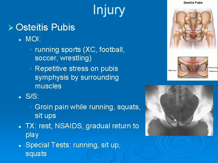 Injury Ø Osteitis Pubis l l MOI: • running sports (XC, football, soccer, wrestling)