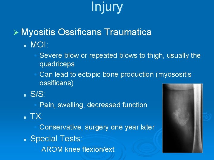 Injury Ø Myositis Ossificans Traumatica l MOI: • Severe blow or repeated blows to