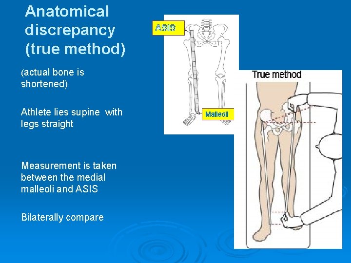 Anatomical discrepancy (true method) ASIS (actual bone is shortened) Athlete lies supine with legs