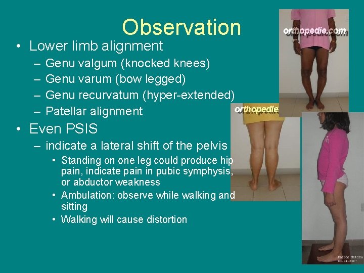 Observation • Lower limb alignment – – Genu valgum (knocked knees) Genu varum (bow