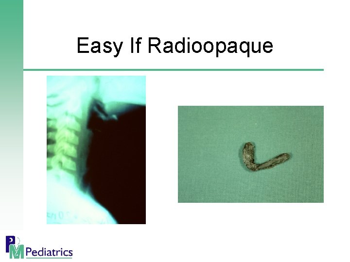 Easy If Radioopaque 