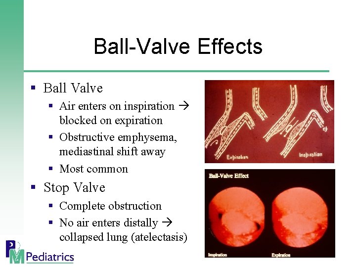 Ball-Valve Effects § Ball Valve § Air enters on inspiration blocked on expiration §