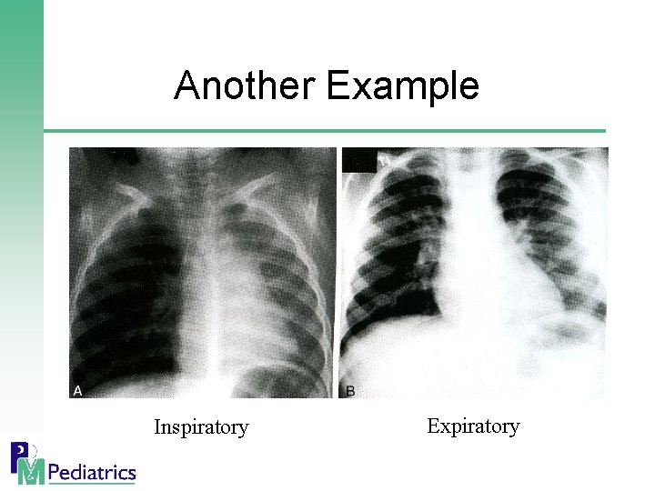 Another Example Inspiratory Expiratory 