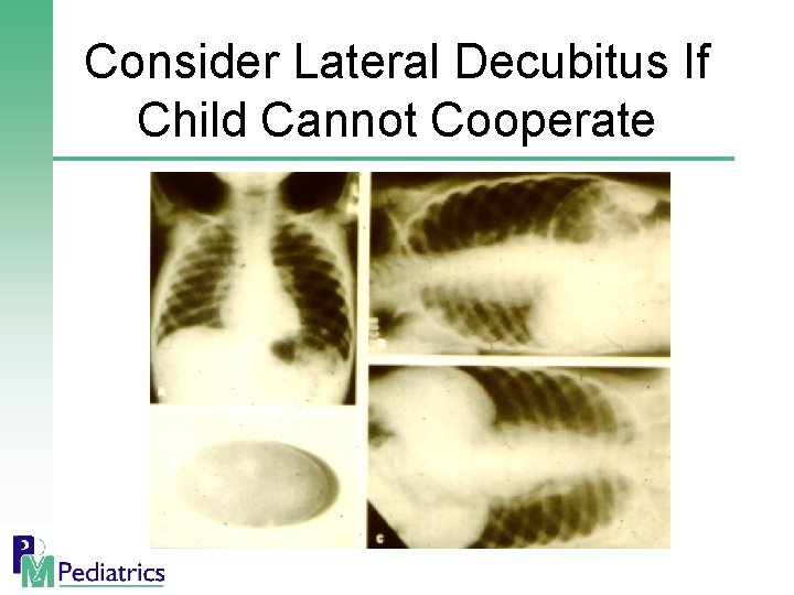 Consider Lateral Decubitus If Child Cannot Cooperate 