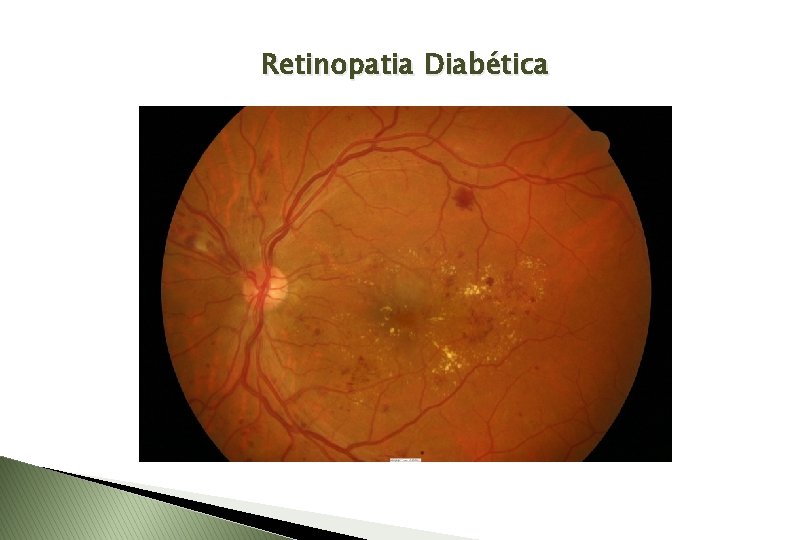 Retinopatia Diabética 