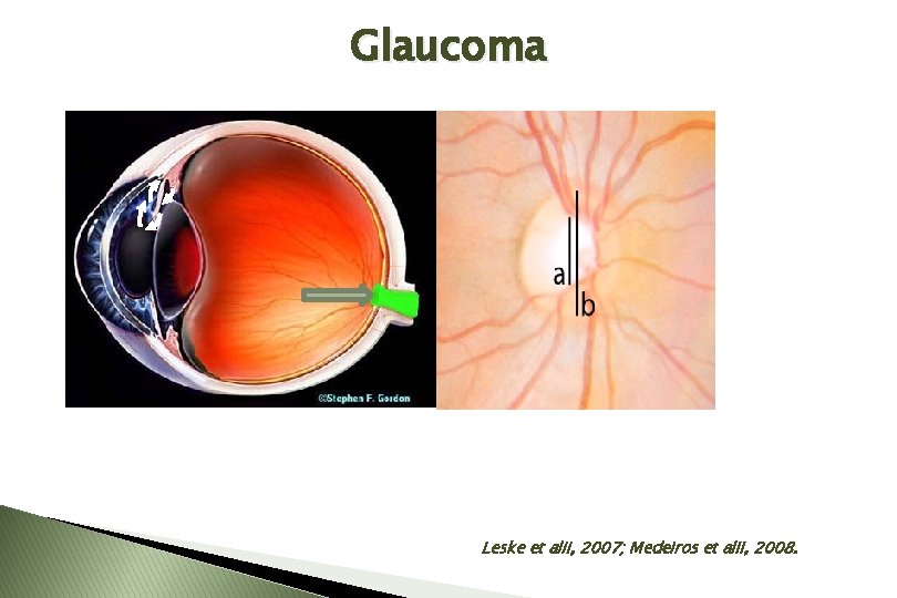 Glaucoma 1 mm Leske et alii, 2007; Medeiros et alii, 2008. 