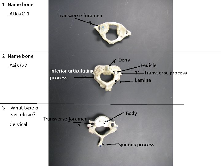 1 Name bone Atlas C-1 Transverse foramen 6 2 Name bone Axis C-2 3