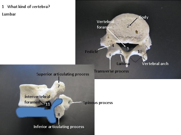 1 What kind of vertebra? Lumbar Body Vertebral foramen 2 4 Pedicle 9 3