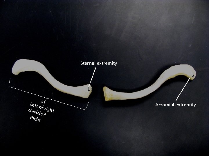 Sternal extremity 2 1 Left 3 o clavi r right cle? Righ t Acromial