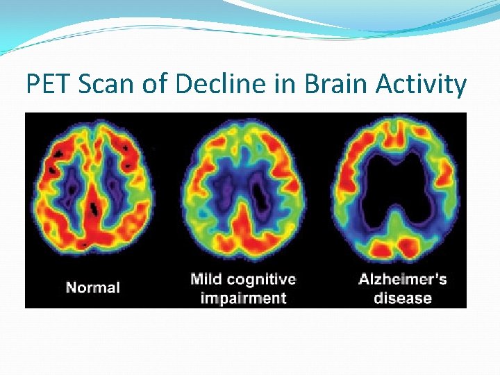 PET Scan of Decline in Brain Activity 