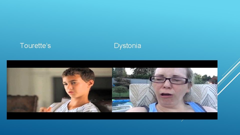 Tourette’s Dystonia 
