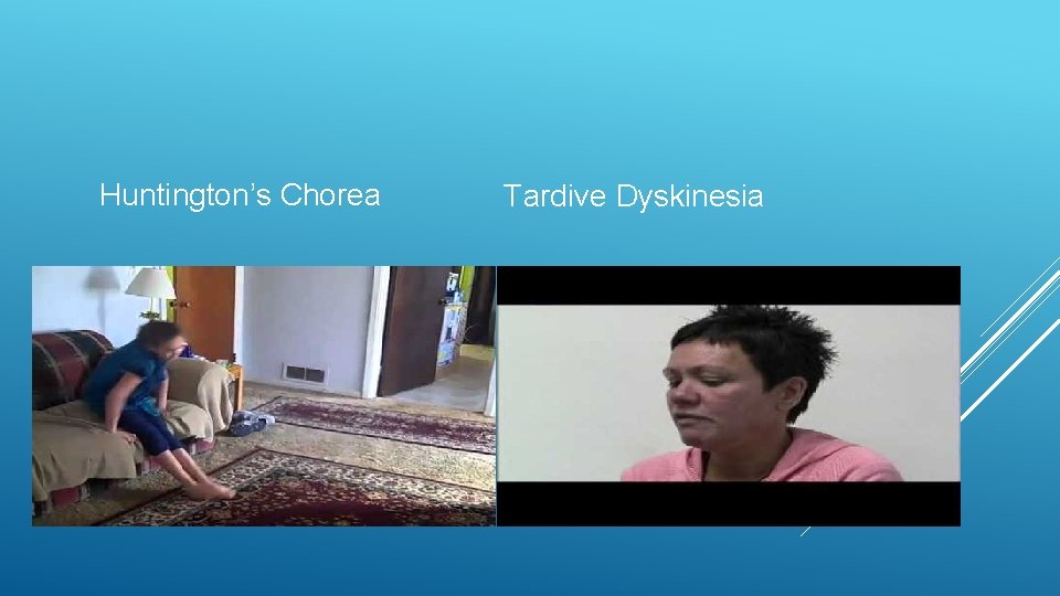 Huntington’s Chorea Tardive Dyskinesia 